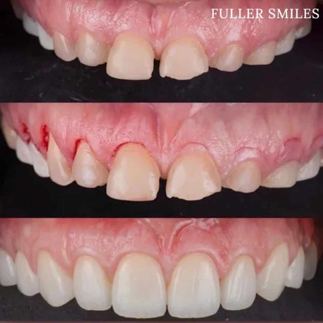 The image shows a series of close-up photographs of an individual s teeth with visible signs of decay and damage, emphasizing the need for dental care.