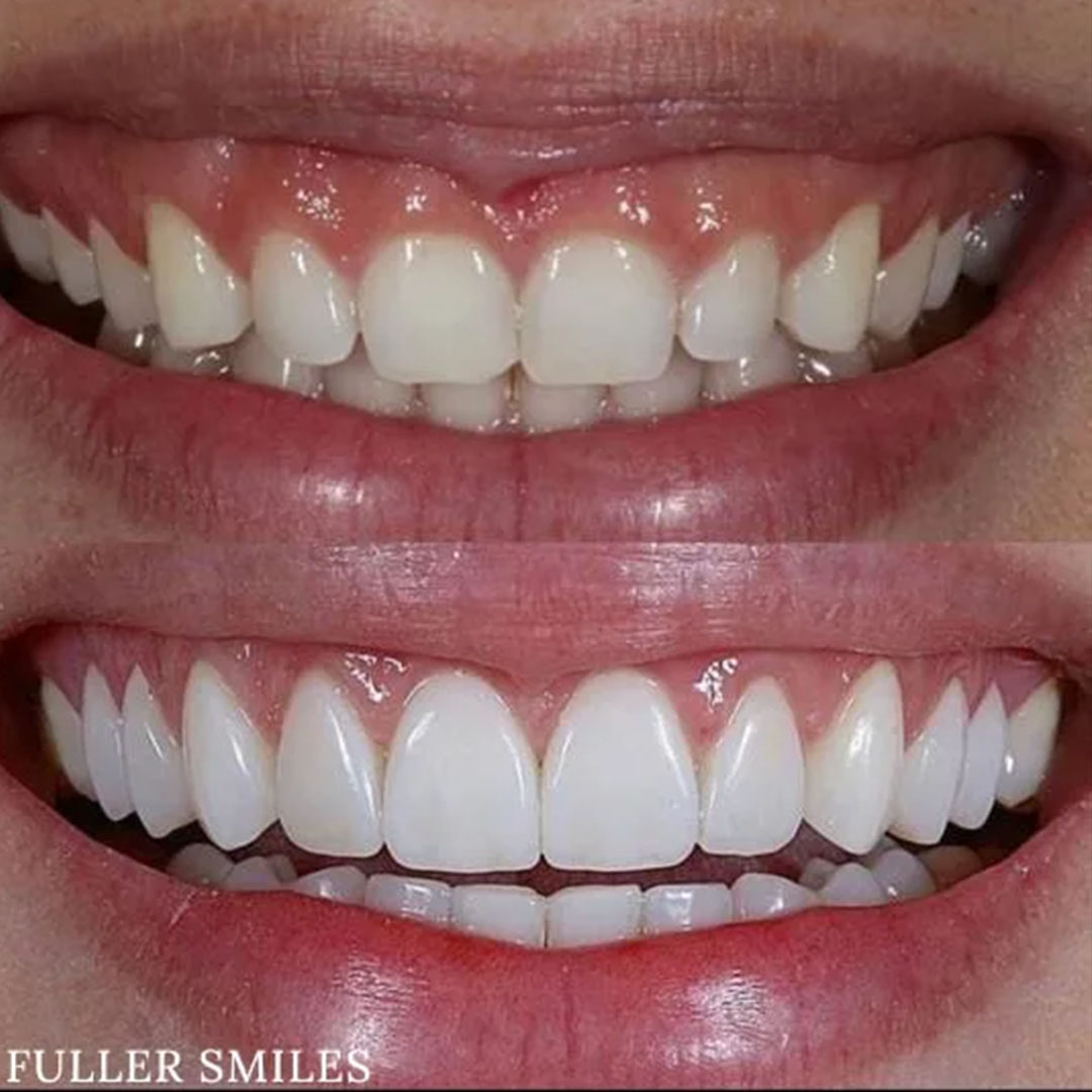 The image displays a person s smile with teeth whitening treatment before and after the procedure, showcasing the transformation from stained to gleaming white teeth.