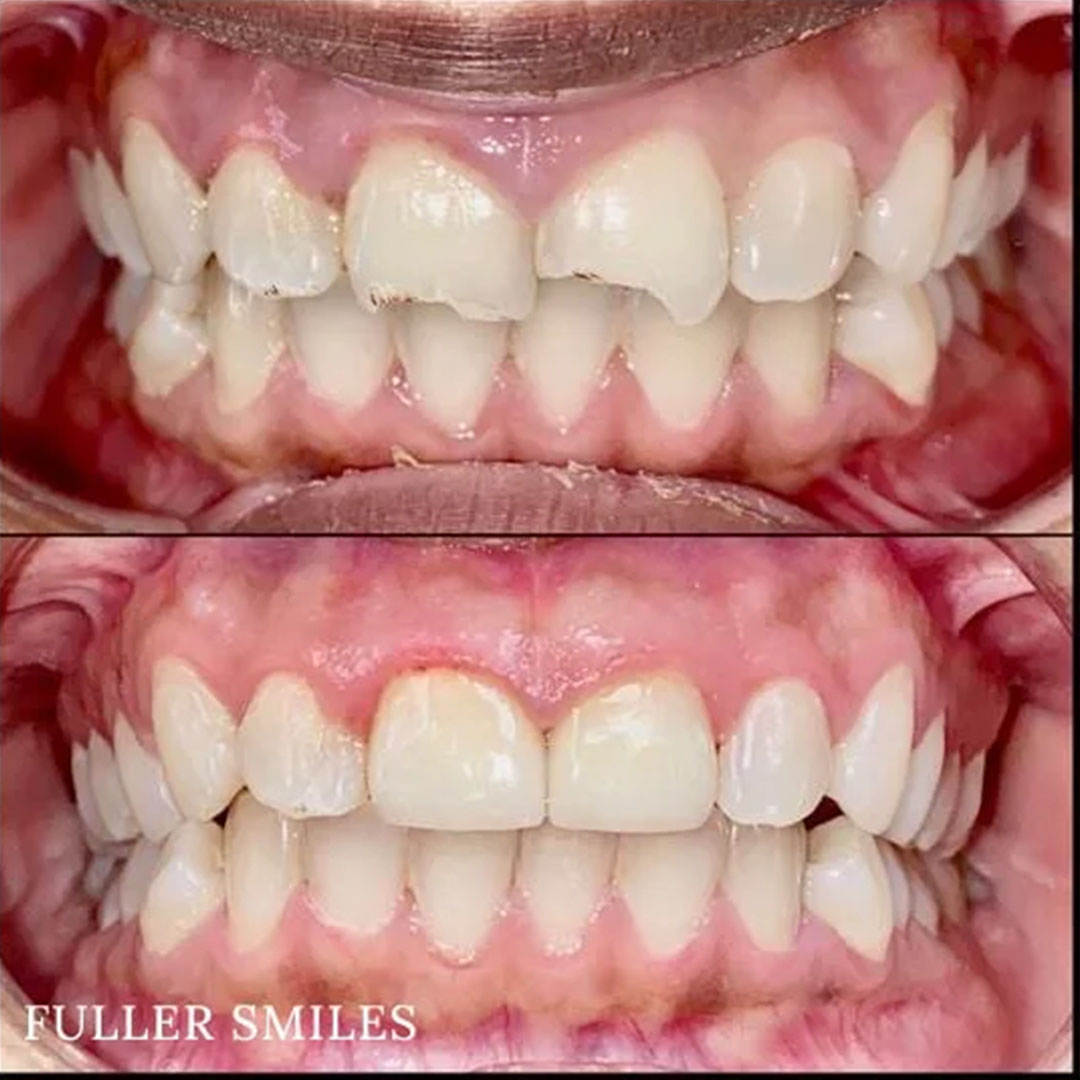 The image displays a side-by-side comparison of four different smiles with varying levels of tooth whitening, showcasing the results of a cosmetic dental treatment from a dentist named FUller Smiles.